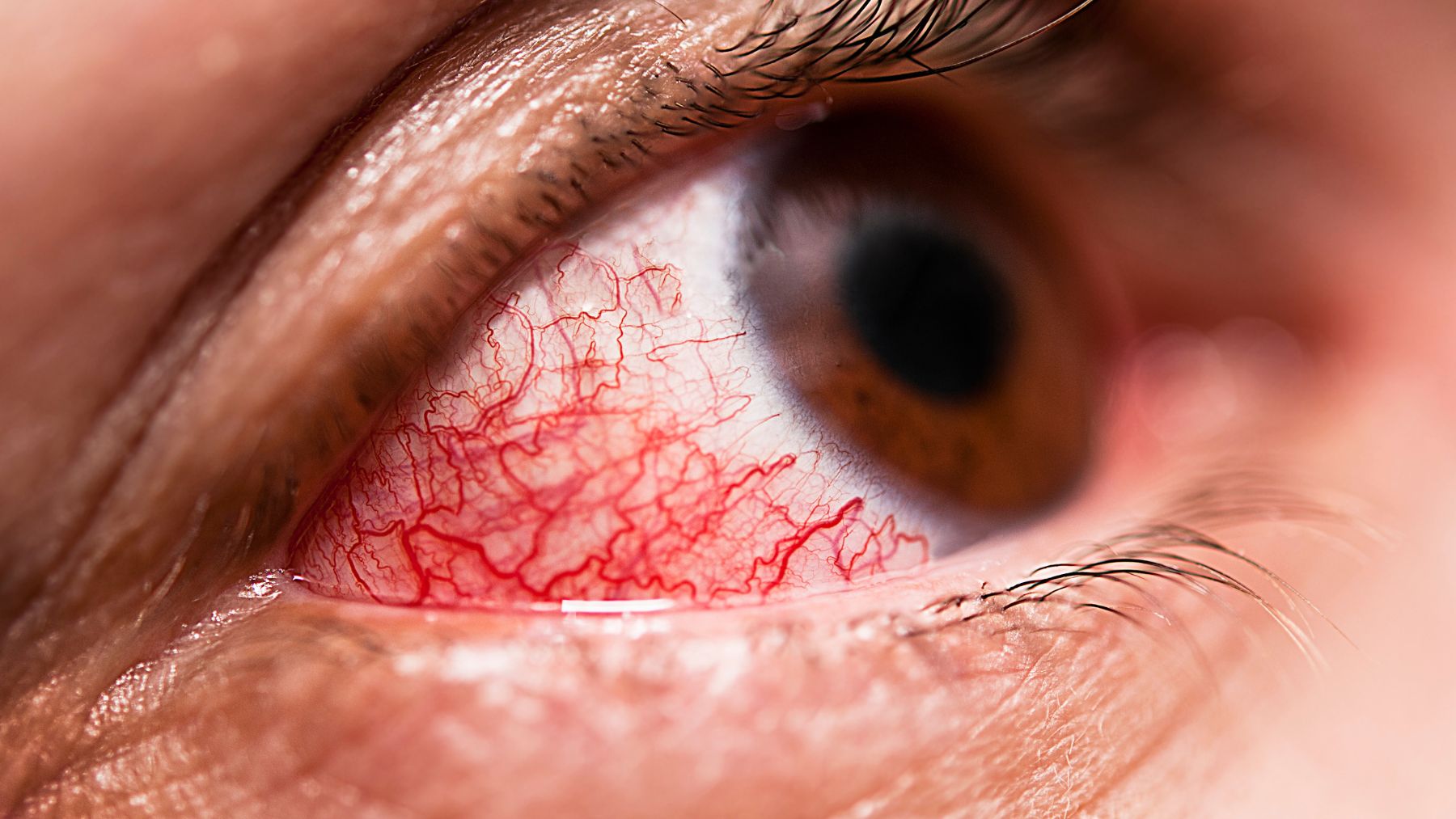 Zapalenie oka: przyczyny, objawy, rodzaje