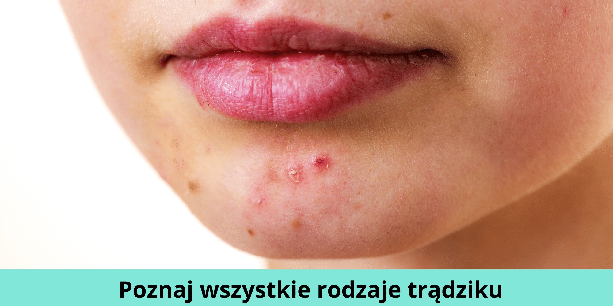 rodzaje trądziku