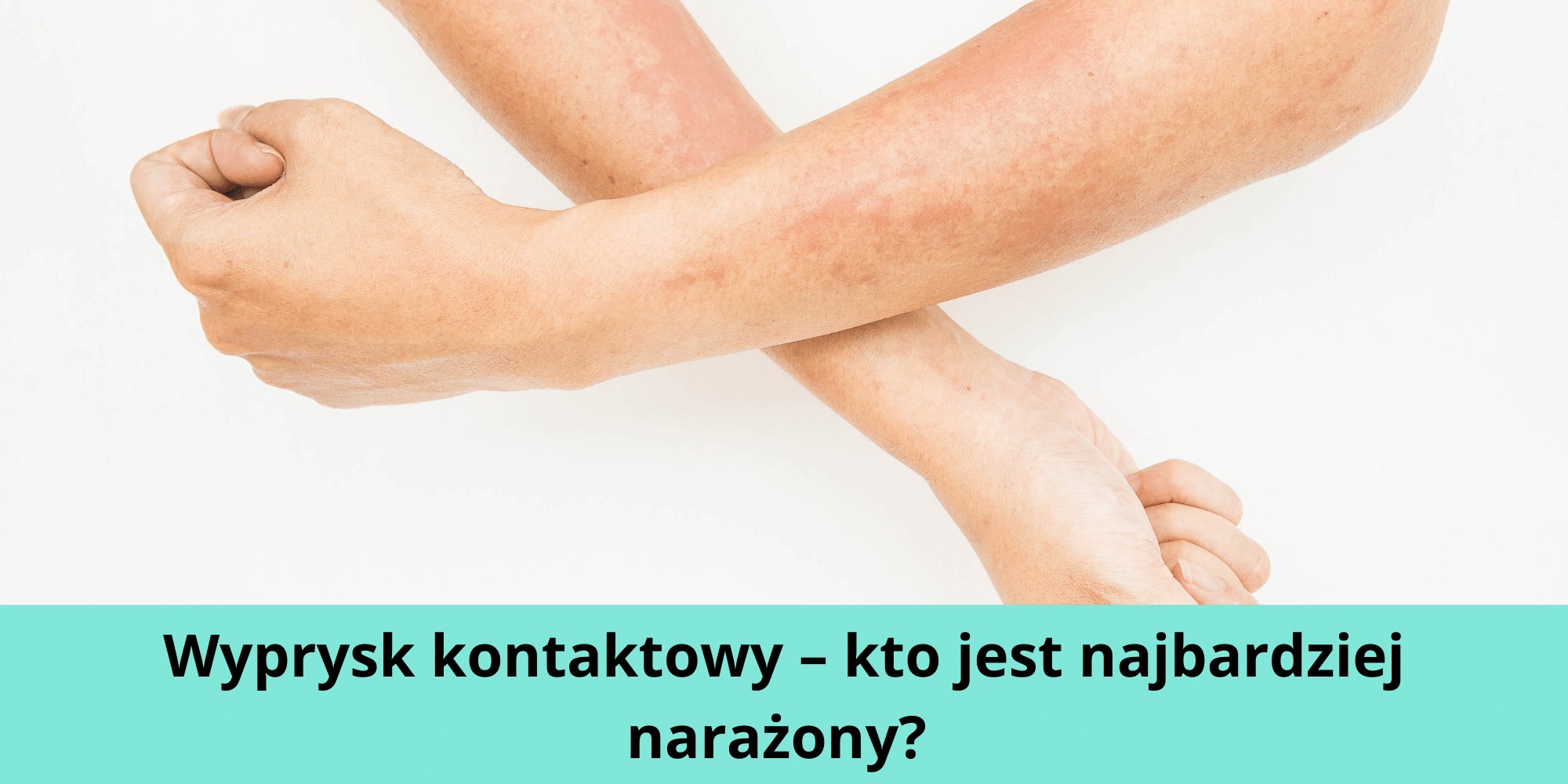 Wyprysk kontaktowy – kto jest najbardziej narażony? 