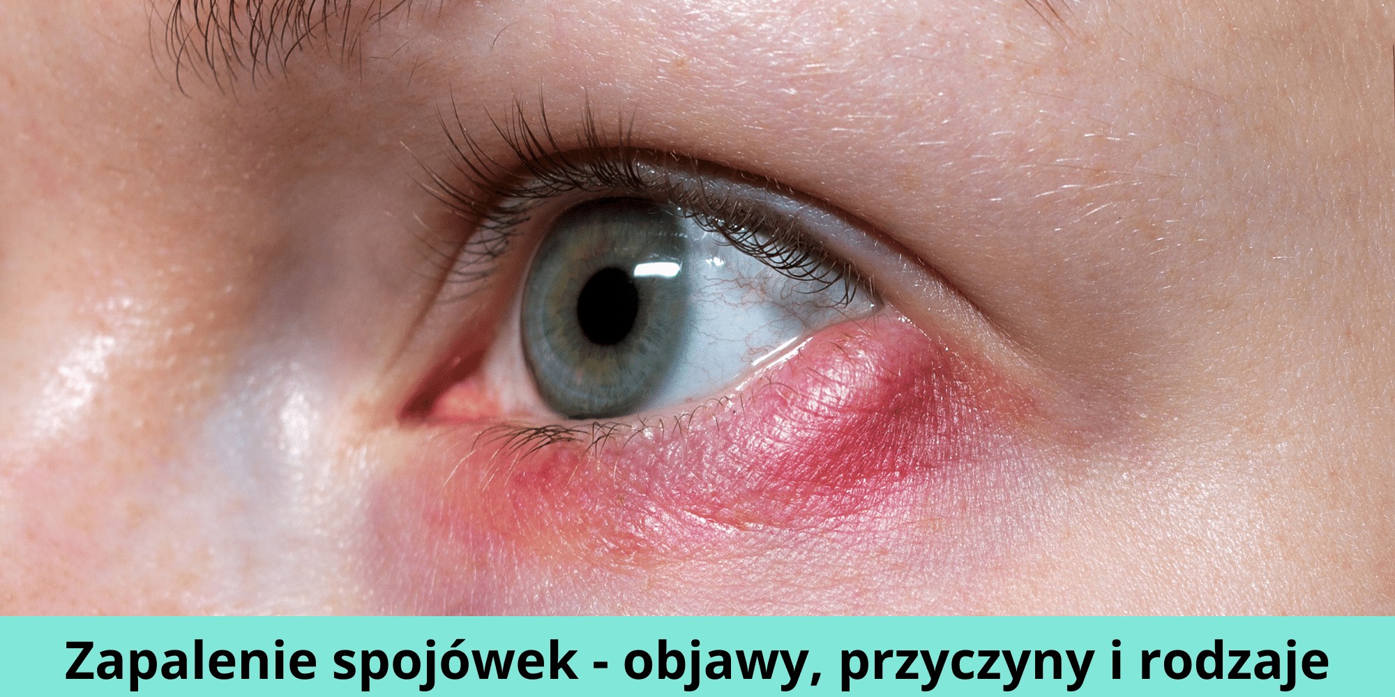 Zapalenie spojówek - objawy, przyczyny i rodzaje